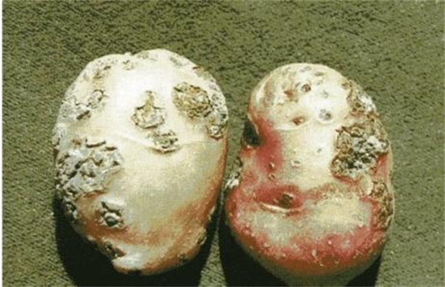 粉痂病